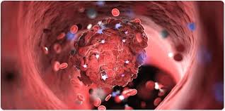 On tuesday evening, a trial of the vaccine in around 300 children was paused while the uk medicines regulator investigates the possibility of links to a rare blood clotting syndrome in adults. Blood Clot Risk And The Oral Contraceptive Pill