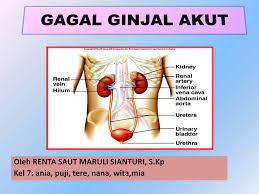 Gagal ginjal adalah penyakit yang menyerang bagian ginjal dan terkategori ke dalam beberapa kondisi yaitu gagal ginjal akut dan kronik. Ppt Gagal Ginjal Akut Powerpoint Presentation Free Download Id 1265851