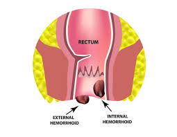 Symptoms of bowel cancer can include a change in your normal bowel habit or blood in your poo. The Difference Between Colon Cancer And Hemorrhoids