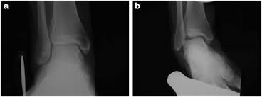 Image result for Talar Tilt