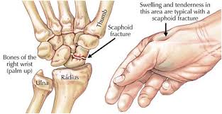 Image result for Scaphoid Fracture Signs