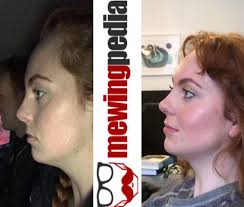 Maybe you would like to learn more about one of these? 7 Mewing Before And After Ideas Jawline Mew Jaw Exercises