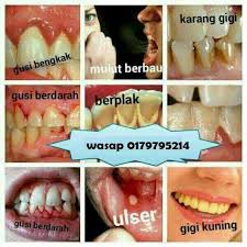 Akan tetapi apabila pendarahan terus terjadi dan menimbulkan rasa sakit yang berkepanjangan tentu hal ini tidak boleh dibiarkan. Pembekal Ubat Gigi Garam Buluh Ubat Gigi Marine Essence Ubat Gigi Marine Essence Ini Tanpa Fluorida Sesuai Untuk Sesi Keluarga Tua Muda Kanak Kanak Di Bawah 6 Tahun Juga Boleh Menggunakan Ubat Gigi Marine