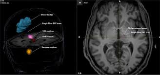 Image result for Thalamotomy
