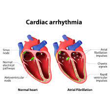 How Serious Is Heart Arrhythmia? Learn More | Vejthani