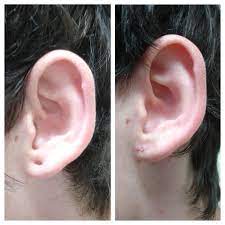 It affects people of all races, genders and ages, which is why it's absolutely critical for americans to learn about. Earlobe Repair2 The Cosmetic Laser And Skin Cancer Centre