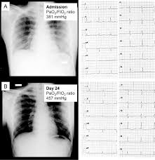 9 in a case series of ten. Electrocardiographic Features Of Patients With Covid 19 Pneumonia European Journal Of Internal Medicine
