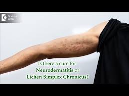 Image result for Neurodermatitis