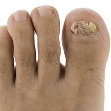 vitamin e oil a cure for toenail fungus
