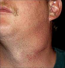 These send information about how our site is used to services called adobe unexplained, persistent lumps in the mouth or the neck that do not go away. Throat Cancer A Typical Patient S Story Texan Ent Specialists