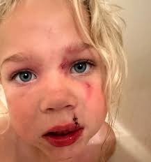 From a mother with a daughter taken to the ER with facial dog wounds, those  teardrop indentations replicate dog bites.