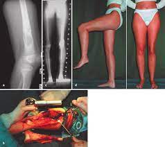 Specifically, it is an aggressive malignant neoplasm that arises from primitive transformed cells of mesenchymal origin (and thus a sarcoma). A 9 Year Old Girl With Osteosarcoma In The Left Distal Femur Limb Download Scientific Diagram