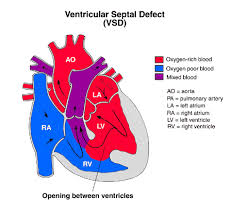 Image result for Ventricular Septal Defect