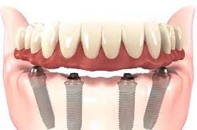 The cost of dental implants can vary depending on where you live due to state spirit dental & vision is an online storefront operated by direct benefits inc., a major insurance provider. Dental Implant Cost In Nyc Implant Dentist 212 Smiling