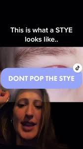 How to Treat a Stye: Nurse's Guide