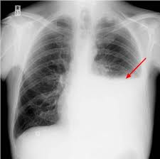 The aetiology of the pleural effusion determines other signs and symptoms. Pleural Effusion Causes Types Symptoms Diagnosis And Treatment