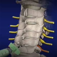 How many epidural steroid injections will medicare cover per year? Cervical Epidural Steroid Injections Segura Pain Center