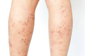 Image result for Atopic eczema atopic dermatitis