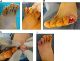 Image result for toe amputation