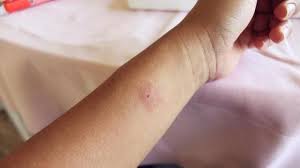 33 Remedes Incroyablement Efficaces Pour Apaiser Une Piqure De Moustique Piqure De Moustique Bouton De Moustique Moustique