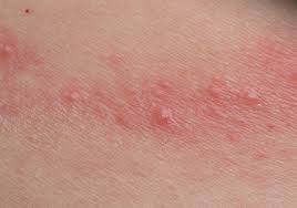 Contact Dermatitis Causes And Risk Factors