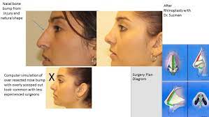 How to change your nose shape. Choosing A Nose Shape And Nose Size When Considering Rhinoplasty