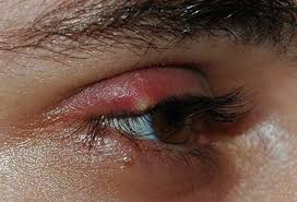 Check spelling or type a new query. Chancroid Picture Image On Medicinenet Com