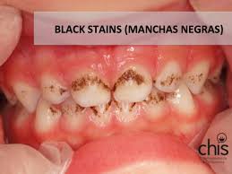 Chis Dental Dra Camila Palma Portaro Black Stains Manchas Negras Hace Unos Dias En El Consultorio Una Mama Me Dijo Que Su Nino De 2 Anos Tenia Unas Manchas Negras