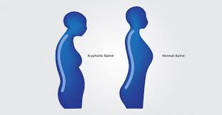 5 Yoga Moves To Get Rid Of Hunchback Or Kyphosis Basic Yoga Poses Yoga Moves Yoga Poses For Back