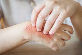 Image result for Atopic Dermatitis