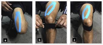 The Effect Of Kinesio Tape On Pain And Vertical Jump Performance In Active Individuals With Patellar Tendinopathy Journal Of Bodywork And Movement Therapies