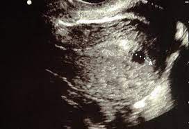 We did not find results for: 6 Weeks Pregnant Ultrasound Procedure Abnormalities And More