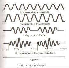 Reported initially in patients with heart failure or stroke, it was then recognized both in. Medicine Conspectus Dispneea DefiniÈie Cauze Caractere Valoare SemiologicÄ Clasificare Simptome Majore