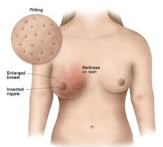 Image result for Inflammatory breast cancer