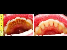 Comment Detartrer Les Dents A La Maison Pour Avoir Des Dents Propres Avec Cette Recette Facile Youtube