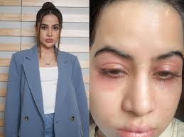 उर्फी जावेद के चेहरे पर सुबह आती है सूजन, ये हो सकता है कारण, क्या सूजा हुआ  फेस किसी बीमारी का लक्षण है? Uorfi Javed face swells in the morning know  what