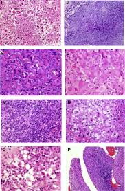How is histology coded when the pathology report final diagnosis is malignant neoplasm, compatible with . Euracan Iaslc Proposals For Updating The Histologic Classification Of Pleural Mesothelioma Towards A More Multidisciplinary Approach Sciencedirect