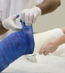 Image result for Ulnar Gutter Cast