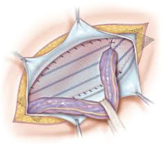 Cel mai des, hernia inghinala de trateaza prin abord clasic, deschis. Hernie Operatie De Hernie Inghinala Dr Stefan Tuca Medic Chirurg