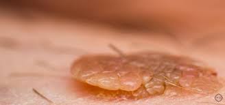 Image result for human papillomavirus symptoms