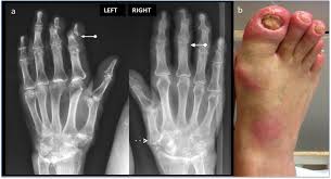 Jan 22, 2015 · psoriatic arthritis is a chronic condition in which the immune system attacks the body, causing joint pain and other symptoms. At The Crossroads Of Gout And Psoriatic Arthritis Psout Springerlink