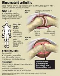 Pin By Mandy Seniors Flourish Occup On Rheumatoid Arthritis Juvenile Rheumatoid Arthritis What Is Rheumatoid Arthritis Rheumatoid Arthritis