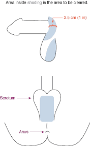 Use of scissors this is the most basic way of removing the pubic hair on the scrotum. Transgender Hair Removal Before Bottom Surgery Transgender Map