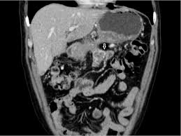 Figure 10 From Imaging Of Obscure Gastrointestinal Bleeding Utility Of Abdominal Ct Scan In Establishing The Diagnosis Semantic Scholar