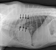 Megaesophagus may also occur in just a segment of the esophagus if there is an obstruction such as a swallowed foreign object, a tumor, a stricture (scar tissue) or if there is a read more in the article link about encephalitis in dogs and cats. Megaesophagus Vetfolio