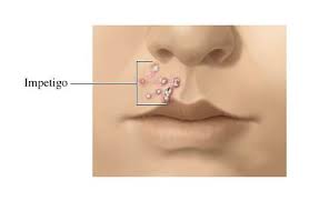 What Is Impetigo Impetigo Blister On Lip Sore Lips