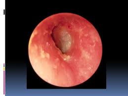 Image result for Necrotizing Otitis Externa