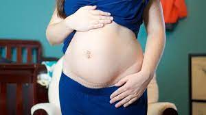 Sakit bersalin selepas pembedahan caesarean masih belum hilang. Jangan Buat 7 Perkara Ini Kalau Anda Bersalin Caesar