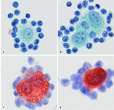 Forty three effusion cytology cbs of 25 confirmed malignant mesotheliomas were compared to cbs of 23 benign mesothelial effusions without inflammation and 13 … A B Conventional Cytology With Benign Mesothelial Cells Surrounded By Download Scientific Diagram