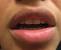 Pimple On Lip Line